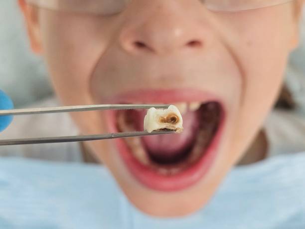 Best Emergency Broken Tooth Repair in Berea, OH